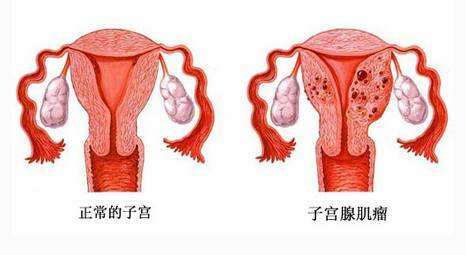 子宮肌瘤是如何導致流產(chǎn)和不孕的