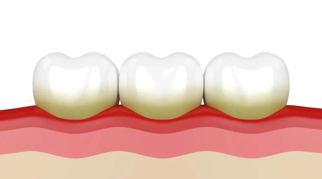 「牙結石」是怎么毀了一口好牙的？