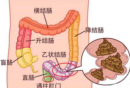 長期便秘的十大危害