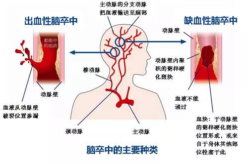 世界卒中日 | 識別卒中早一秒，挽救大腦恢復(fù)好